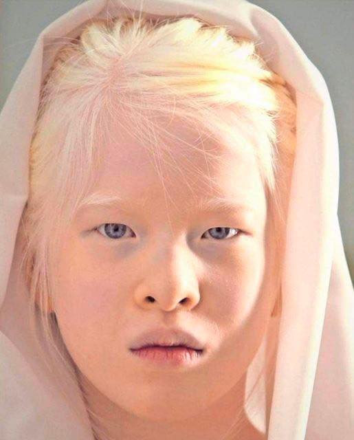 Girl Abandoned By Parents For Her Looks Wants To Prove The World Wrong – Now She Models For Vogue